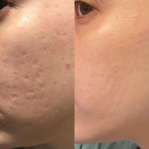 Losveo™ Premium Silicone Scar Sheets for Effective Scar Reduction & Healing